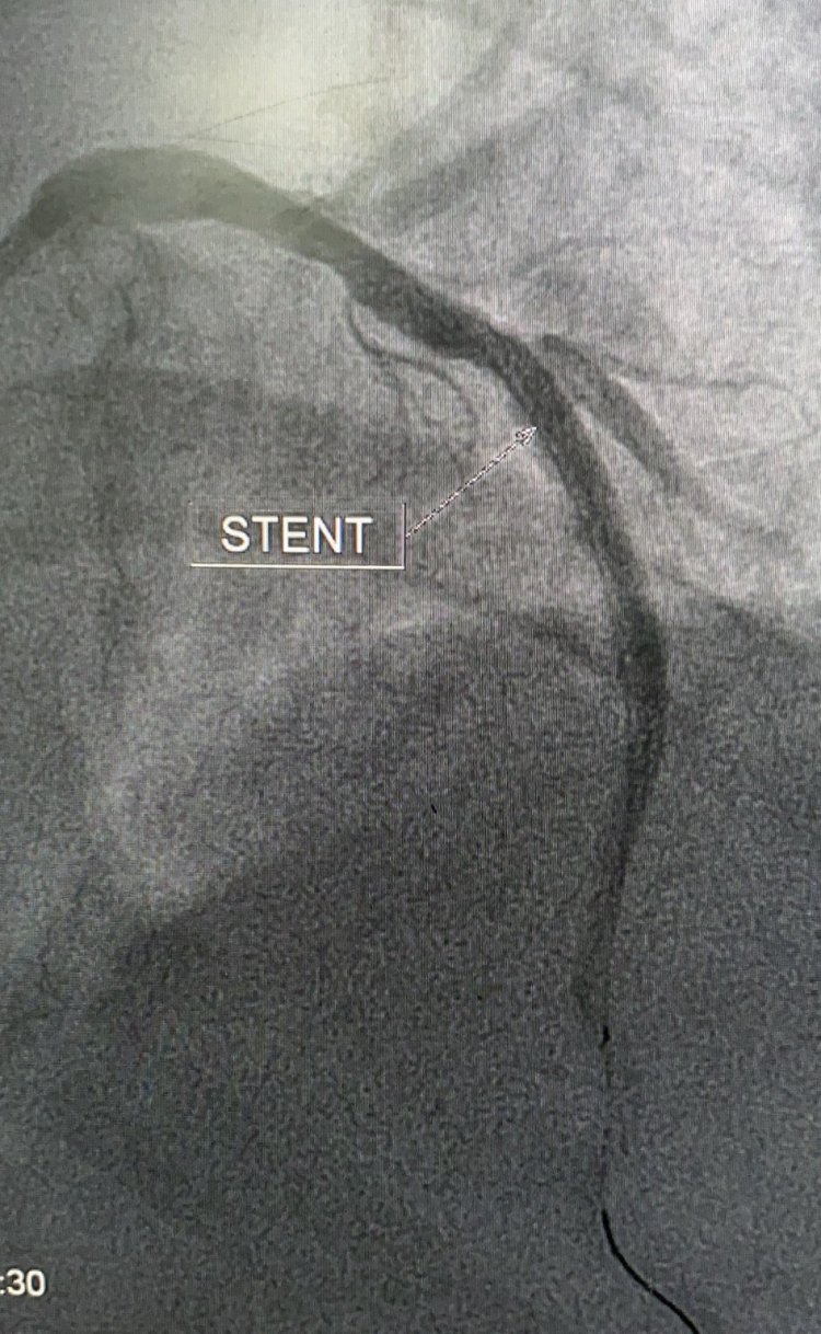 Can Thiệp Mạch Vành Cứu Sống Nhiều Người Bệnh Nhồi Máu Cơ Tim Tại Bệnh Viện Hữu Nghị Việt Nam – Cuba Đồng Hới