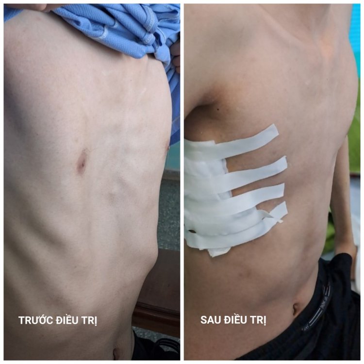 Điều Trị Bệnh Lõm Ngực