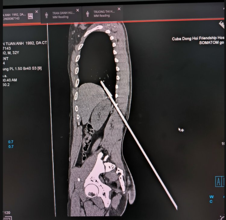 Cấp Cứu Và Xử Trí Thành Công Bệnh Nhân Có Vết Thương Thấu Ngực, Phổi Do Dị Vật Sắc Nhọn Hình Mũi Tên Gây Ra