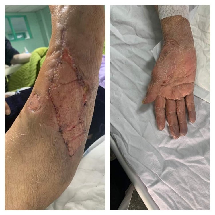 Phẫu Thuật Thành Công Chấn Thương - Vết Thương Mạch Máu Cho Nữ Bệnh Nhân Cao Tuổi