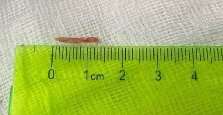 Phẫu Thuật Thành Công Trường Hợp Hiếm Gặp Cho Bệnh Nhân Dài Mỏm Trâm