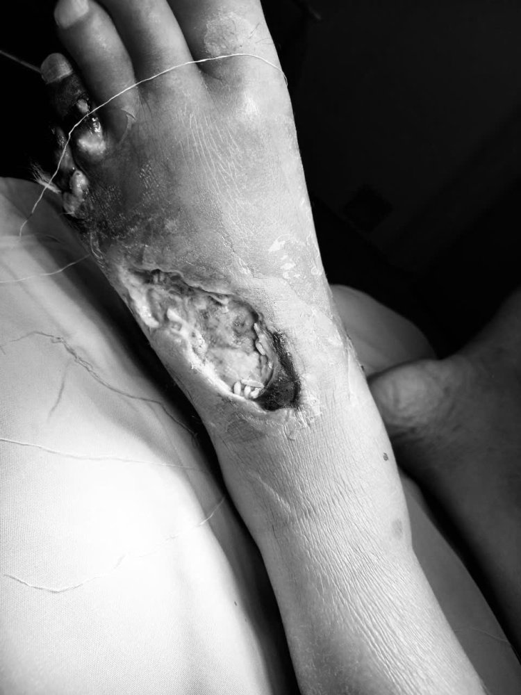 Cứu Bàn Chân Thoát Khỏi Cắt Cụt Cho Nam Bệnh Nhân Mắc Chứng Tiểu Đường