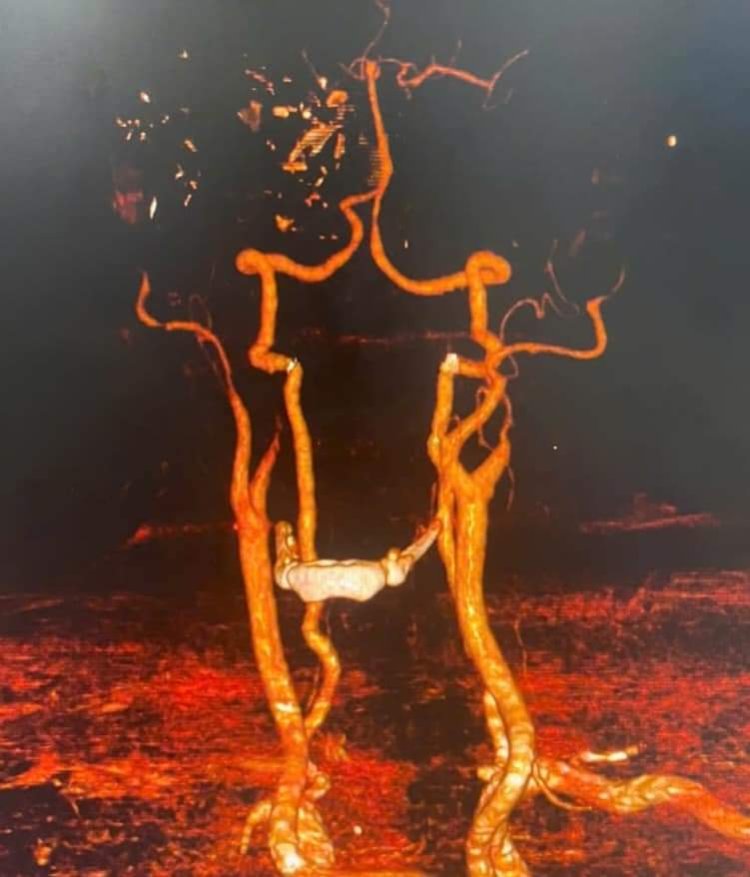 Kéo, Hút Huyết Khối Động Mạch Não Cho Người Bệnh Bị Đột Quỵ Cấp