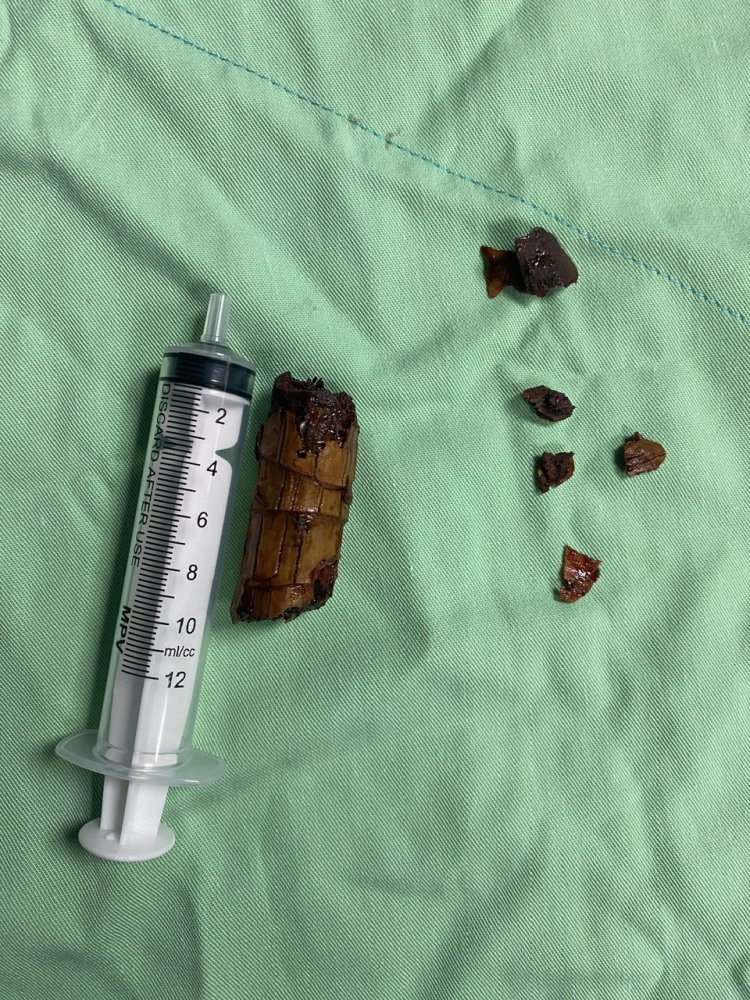 Bị Khúc Gỗ Đâm Xuyên Góc Hàm Vào Tận Cổ Gây Nguy Hiểm Đến Tính Mạng