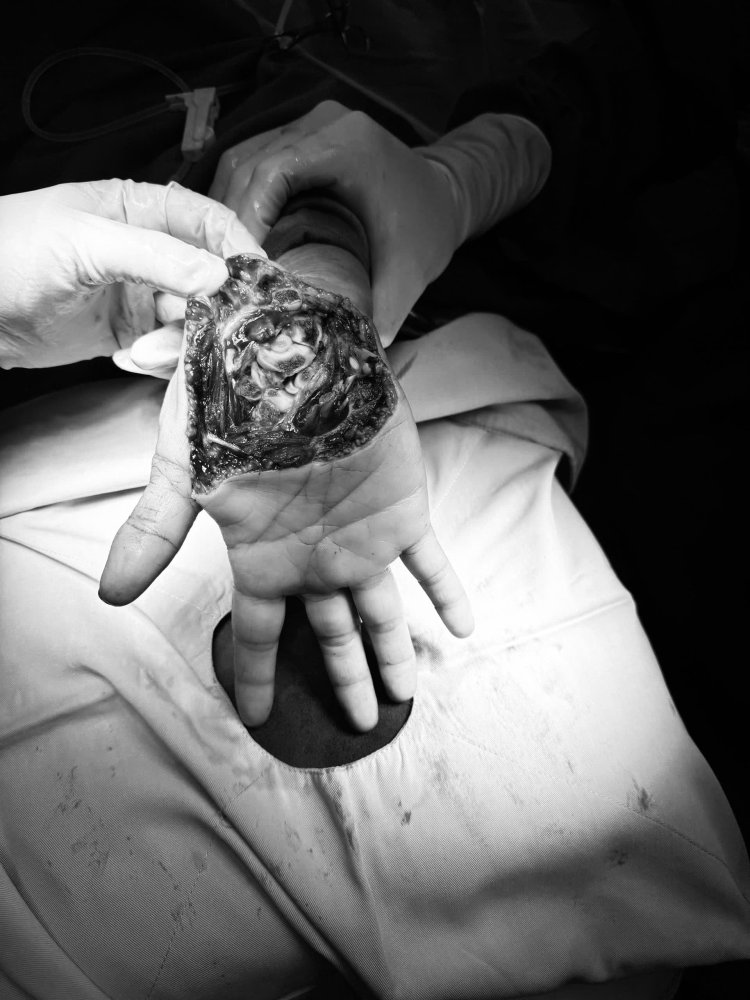 Cứu sống bàn tay đứt lìa gần hoàn toàn cho nữ bệnh nhân