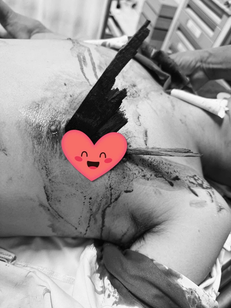 Cứu sống nam thanh niên bị thanh gỗ đâm xuyên ngực sau tai nạn xe máy