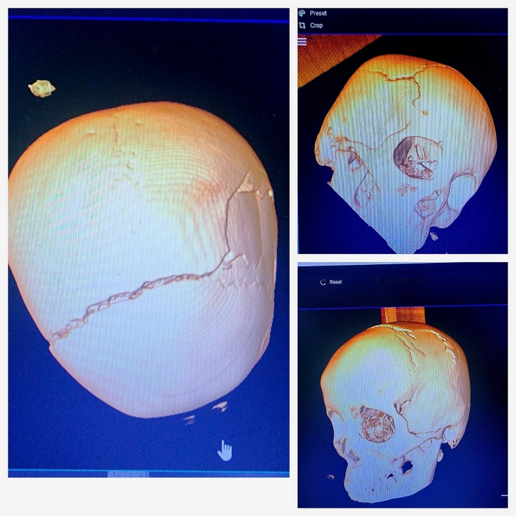 Chạy đua với thời gian: Hai lần phẫu thuật cấp cứu trong đêm cứu sống nam bệnh nhân bị chấn thương sọ não nặng do tai nạn