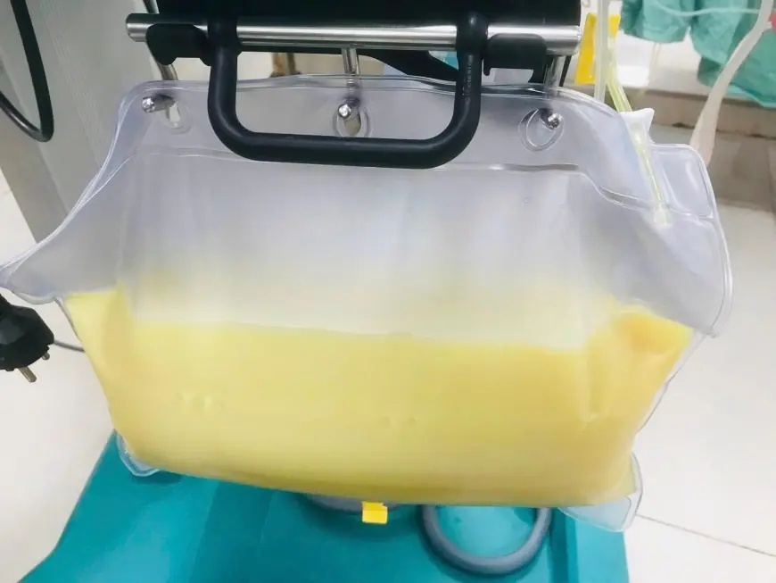 Huyết tương của bệnh nhân được lấy ra đục như sữa bằng kỹ thuật thay huyết tương