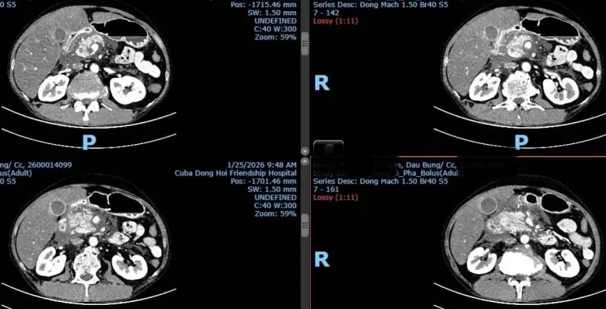 Kết quả chụp cắt lớp vi tính ổ bụng: Hình ảnh viêm tuỵ cấp Balthazar E