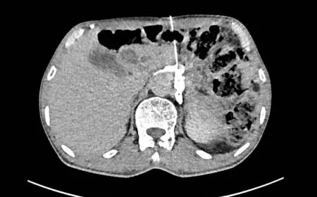 Phẫu Thuật Cắt Khối U, Ghép Da Mặt Cho Cụ Bà 87 Tuổi